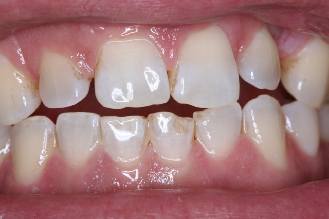 Lower Chipped Tooth Before